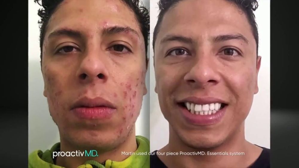 proactiv reviews before and after