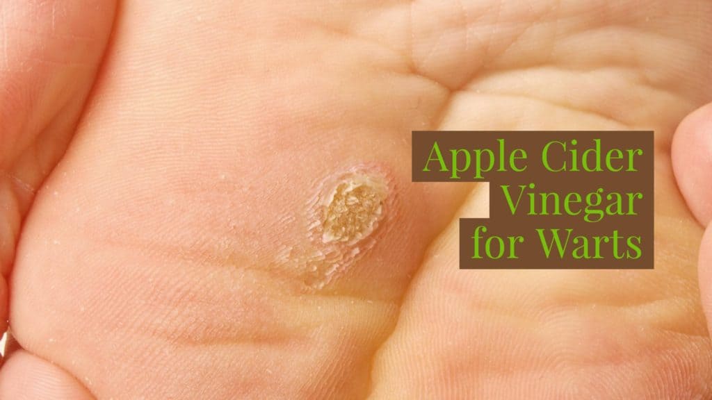 apple cider vinegar wart removal review