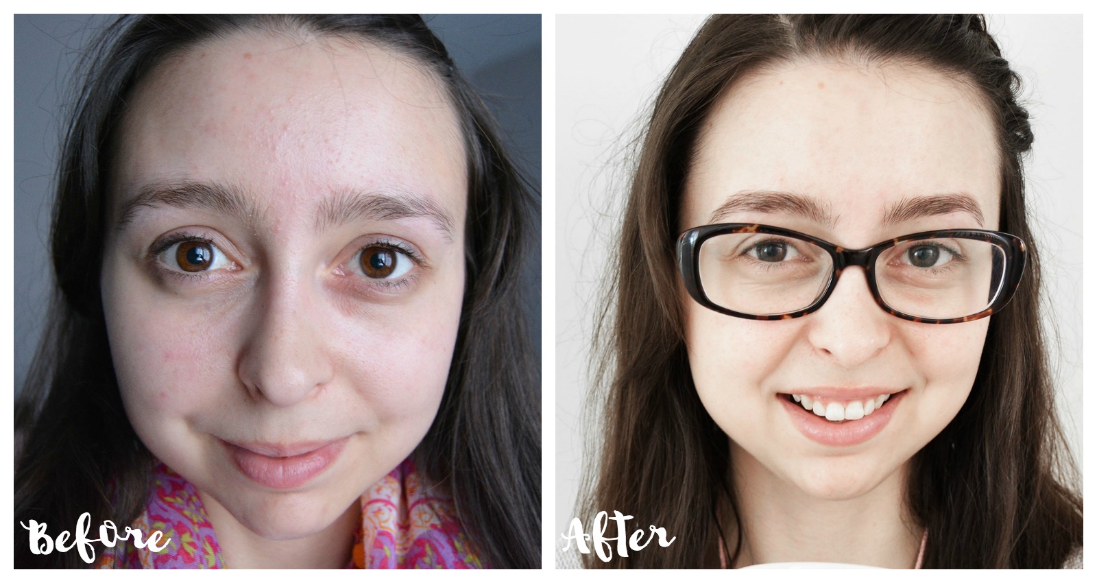 proactiv reviews before and after