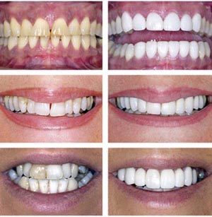 brighter white teeth whitening reviews
