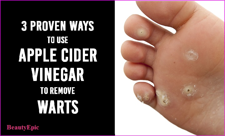 apple cider vinegar wart removal review