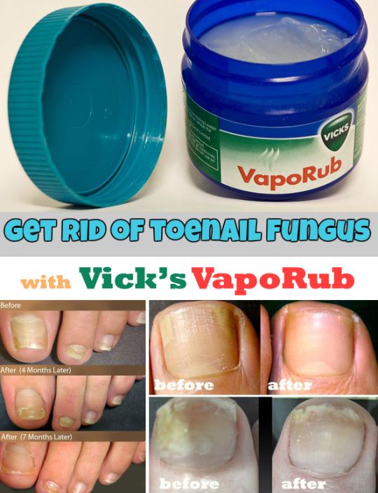 vicks for toenail fungus review